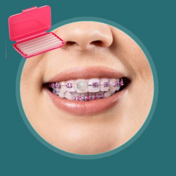 موم ارتودنسی برای کاهش تحریک بافت دهان موم ارتودنسی روی براکت ها برای جلوگیری از زخم و تحریک لب و گونه