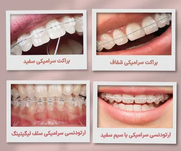 انواع ارتودنسی سرامیکی؛ شفاف، سفید، سیم سفید و سلف لیگیتینگ مقایسه انواع ارتودنسی سرامیکی شامل براکت سرامیکی شفاف، براکت همرنگ دندان، ارتودنسی سرامیکی با سیم سفید و براکت سرامیکی سلف لیگیتینگ