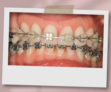 ارتودنسی سرامیکی فک بالا و ارتودنسی فلزی فک پایین نمونه درمان با براکت سرامیکی در فک بالا و براکت فلزی در فک پایین برای ایجاد تعادل بین زیبایی و هزینه درمان ارتودنسی