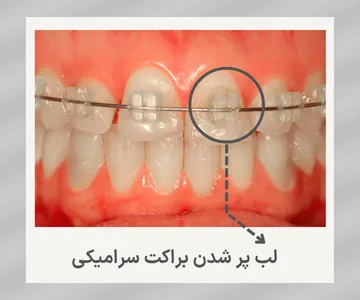براکت سرامیکی ارتودنسی که دچار شکستگی یا لب‌پرشدگی شده و نیاز به بررسی و تعویض توسط متخصص ارتودنسی دارد.