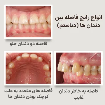 انواع فاصله بین دندانها (دیاستم) و علل ایجاد آن تصویر شامل سه نمونه از دیاستم: فاصله بین دندانهای جلو، دیاستم ناشی از نبود دندان و فاصلههای متعدد ایجاد شده به علت کوچک بودن اندازه دندانها نسبت به فضای فک.