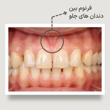 فرنوم لب بالا؛ یکی از علل ایجاد فاصله بین دندانهای جلو (دیاستم) تصویر فرنوم لب بالا که با فلش مشخص شده است؛ فرنوم ضخیم یا با اتصال پایین میتواند یکی از عوامل ایجاد یا حفظ فاصله بین دندانهای جلویی (دیاستم) باشد.