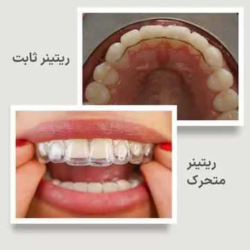 ریتینر ثابت و ریتینر متحرک؛ نگهدارندههای ارتودنسی پس از بستن دیاستم تصویر مقایسهای ریتینر ثابت پشت دندانها و ریتینر متحرک شفاف که برای حفظ نتیجه درمان و جلوگیری از بازگشت فاصله بین دندانها (دیاستم) استفاده میشوند.