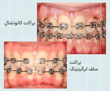 مقایسه براکت فلزی معمولی و سلف لیگیتینگ مقایسه براکت فلزی کانونشنال و سلف لیگیتینگ از نظر ساختار و نحوه نگهداری سیم ارتودنسی