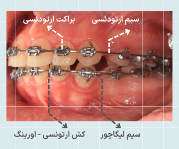 اجزای ارتودنسی فلزی شامل براکت سیم واورینگ تصویر اجزای ارتودنسی فلزی شامل براکت سیم ارتودنسی و اورینگ روی دندان