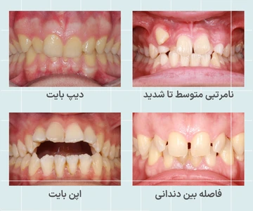 ارتودنسی فلزی برای درمان شلوغی دندان دیپ بایت اپن بایت و فاصله بین دندانها تصویر ناهنجاریهای قابل درمان با ارتودنسی فلزی شامل شلوغی دندان دیپ بایت اپن بایت و فاصله بین دندانها