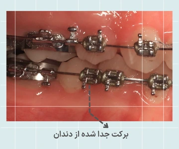 براکت ارتودنسی فلزی کنده شده از روی دندان براکت ارتودنسی فلزی جدا شده از دندان که روی سیم باقی مانده و نیاز به مراجعه به متخصص دارد