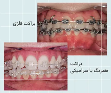 مقایسه ارتودنسی فلزی و سرامیکی مقایسه ظاهری ارتودنسی فلزی و ارتودنسی سرامیکی از نظر رنگ براکت و میزان دیده شدن روی دندان