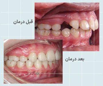 قبل و بعد اصلاح بایت با ارتودنسی فلزی تصاویر قبل و بعد اصلاح ناهنجاری بایت و هماهنگ شدن فک و دندانها با ارتودنسی فلزی