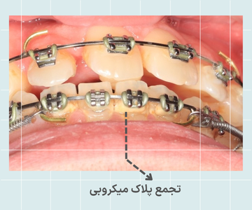 تجمع پلاک اطراف براکت ارتودنسی فلزی تجمع پلاک میکروبی اطراف براکت ارتودنسی فلزی در اثر رعایت نکردن بهداشت دهان و دندان