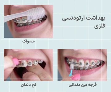 رعایت بهداشت دهان در طول درمان ارتودنسی فلزی رعایت بهداشت دهان و دندان در طول درمان ارتودنسی فلزی با استفاده از مسواک و نخ دندان مخصوص