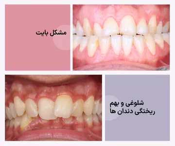 تصویر آموزشی از موارد نامناسب برای درمان با کامپوزیت شامل نامرتبی شدید دندان‌ها، شلوغی دندانی و مشکلات بایت که معمولاً به ارتودنسی نیاز دارند.