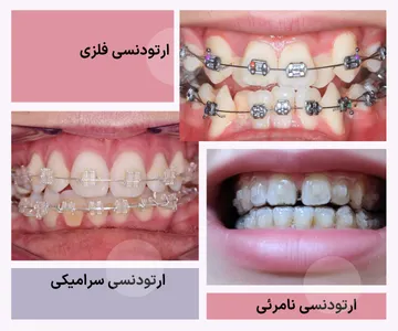 تصویر مقایسه‌ای انواع ارتودنسی شامل ارتودنسی فلزی، ارتودنسی سرامیکی و ارتودنسی نامرئی با الاینر شفاف