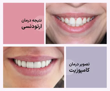 قایسه نتیجه ارتودنسی واقعی با نمونه کامپوزیت دندانی برای نمایش تفاوت درمان