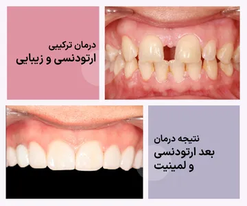 مقایسه نمای روبروی دندان‌ها قبل از درمان و نتیجه نهایی پس از ارتودنسی و لمینیت