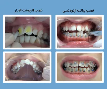 نصب براکت ارتودنسی و اتچمنت الاینر در شروع درمان تصویر مقایسه نصب براکت ارتودنسی و اتچمنت الاینر شفاف در مرحله شروع درمان ارتودنسی