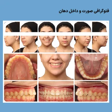 فتوگرافی صورت و داخل دهان برای مدارک تشخیصی ارتودنسی عکس فتوگرافی صورت و داخل دهان بیمار برای ثبت مدارک تشخیصی و برنامهریزی درمان ارتودنسی