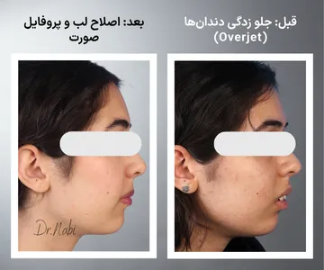 مقایسه نیمرخ صورت قبل و بعد از ارتودنسی با کاهش جلو زدگی دندان‌ها و بهبود فرم لب‌ها
