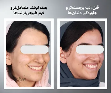  مقایسه قبل و بعد فرم لبخند پس از ارتودنسی؛ پهن‌تر شدن قوس لبخند، مرتب شدن دندان‌ها و بهبود زیبایی لبخند