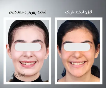 مقایسه قبل و بعد فرم لبخند پس از ارتودنسی؛ پهن‌تر شدن قوس لبخند، مرتب شدن دندان‌ها و بهبود زیبایی لبخند