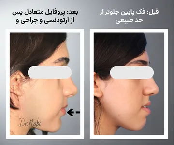 مقایسه نیم‌رخ قبل و بعد جراحی فک و ارتودنسی در بیمار دارای جلو بودن فک پایین (آندربایت) با بهبود پروفایل و هماهنگی صورت