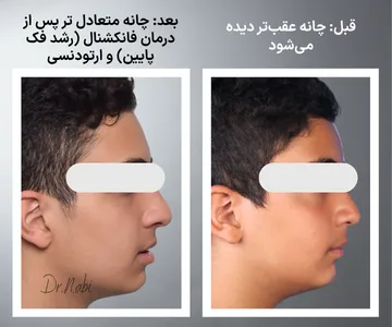 مقایسه قبل و بعد درمان فانکشنال و ارتودنسی در بیمار دارای عقب بودن فک پایین؛ بهبود رشد فک پایین و متعادل‌تر دیده شدن چانه و پروفایل نیم‌رخ صورت