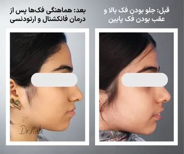 مقایسه قبل و بعد درمان فانکشنال و ارتودنسی در بیمار دارای جلو بودن فک بالا و عقب بودن فک پایین با بهبود رابطه فک‌ها، پروفایل صورت و اکلوژن