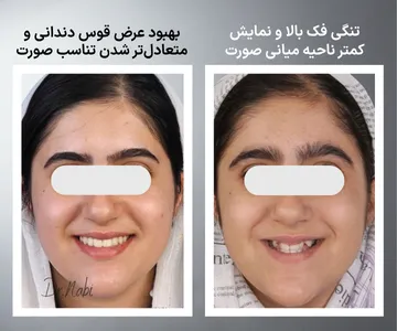 مقایسه قبل و بعد درمان ارتودنسی همراه با گسترش فک بالا (پالیتال اکسپنشن) در بیمار دارای تنگی فک بالا؛ بهبود عرض قوس دندانی و تغییر ادراک ناحیه میانی صورت و گونه‌ها بدون تغییر استخوان زیگوماتیک