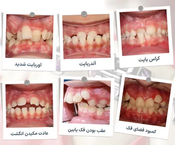 کلاژ ناهنجاری‌های دندانی و فکی شامل کراس بایت، آندربایت، اوربایت، کمبود فضای دندان، عقب بودن فک پایین و اپن بایت ناشی از مکیدن انگشت در کودکان