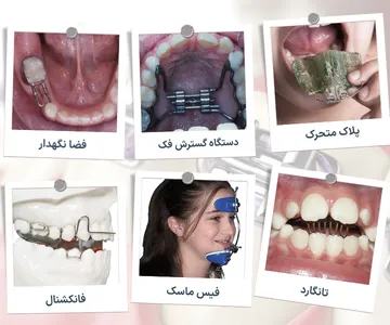 کلاژ دستگاه‌های ارتودنسی پیشگیرانه شامل پلاک متحرک، دستگاه گسترش فک، فضا نگهدار، تانگارد، فیس ماسک و دستگاه فانکشنال برای درمان ناهنجاری‌های دندانی و فکی کودکان