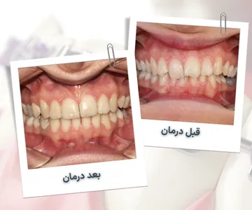 مقایسه قبل و بعد درمان ارتودنسی در بیمار ۳۵ ساله با نامرتبی متوسط دندان‌ها و اصلاح خط میانی لبخند