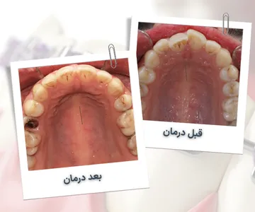 نمای اکلوزال فک پایین قبل و بعد از درمان ارتودنسی در بیمار ۳۵ ساله و اصلاح نامرتبی دندان‌ها