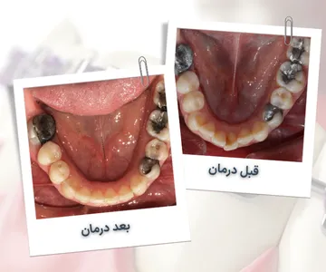 نمای اکلوزال فک پایین قبل و بعد از درمان ارتودنسی در بیمار ۳۵ ساله و اصلاح نامرتبی دندان‌ها