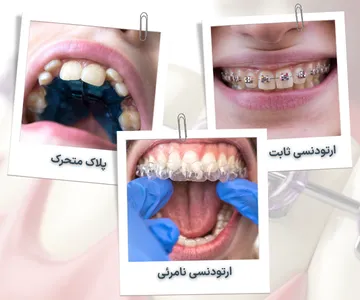 کلاژ مقایسه‌ای شامل ارتودنسی ثابت با براکت، پلاک متحرک ارتودنسی و ارتودنسی نامرئی برای آشنایی با روش‌های مختلف درمان ناهنجاری‌های دندانی