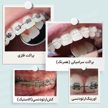 اجزای ارتودنسی ثابت شامل براکت فلزی، براکت سرامیکی، اورینگ و کش ارتودنسی مقایسه اجزای ارتودنسی ثابت شامل براکت فلزی، براکت سرامیکی همرنگ دندان، اورینگ و کش ارتودنسی