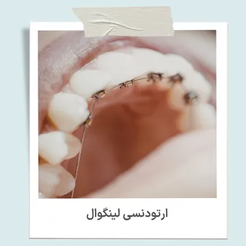 ارتودنسی لینگوال با نصب براکت در پشت دندان ها ارتودنسی لینگوال با براکت های نصب شده در سطح داخلی و پشت دندان ها