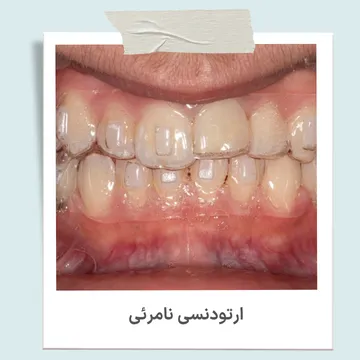 ارتودنسی نامرئی با الاینر شفاف ارتودنسی نامرئی با الاینر شفاف برای مرتب کردن دندان ها بدون براکت فلزی