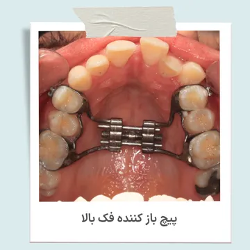 پیچ باز کننده فک بالا برای درمان تنگی فک پیچ باز کننده فک بالا در ارتودنسی برای افزایش عرض فک و درمان تنگی فک بالا