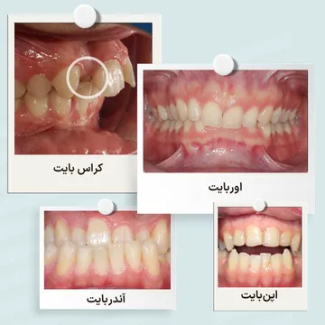 انواع ناهنجاری های بایت شامل اوربایت، آندربایت، اپن بایت و کراس بایت مقایسه انواع ناهنجاری های بایت شامل اوربایت، آندربایت، اپن بایت و کراس بایت که با ارتودنسی قابل درمان هستند