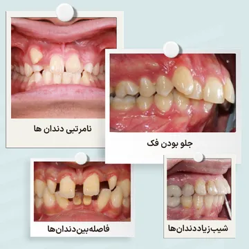 مشکلات قابل درمان با ارتودنسی شامل نامرتبی دندان ها، فاصله دندانی و ناهنجاری فک نمونه ای از مشکلات قابل درمان با ارتودنسی شامل جلو بودن فک، فاصله بین دندان ها، شیب زیاد دندان ها و نامرتبی دندان ها
