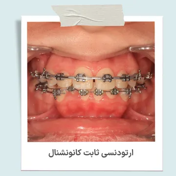 ارتودنسی ثابت کانونشنال با براکت فلزی ارتودنسی ثابت کانونشنال با براکت فلزی و سیم ارتودنسی روی دندان ها
