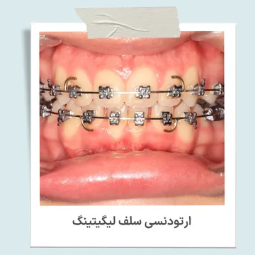 ارتودنسی سلف لیگیتینگ یا دیمون بدون اورینگ براکت سلف لیگیتینگ دیمون که سیم ارتودنسی را بدون استفاده از اورینگ نگه می دارد