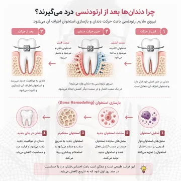 چرا دندان ها بعد از ارتودنسی درد میگیرند؟ دیاگرام حرکت دندان و بازسازی استخوان دیاگرام حرکت دندان در ارتودنسی که نشان میدهد نیروی ارتودنسی باعث تحلیل استخوان در سمت فشار، تشکیل استخوان جدید در سمت کشش و بازسازی استخوان اطراف دندان میشود.