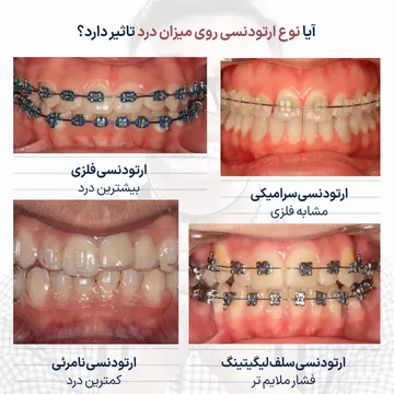 مقایسه درد در انواع ارتودنسی؛ فلزی، سرامیکی، سلف لیگیت و نامرئی تصویر مقایسه ای میزان درد در انواع ارتودنسی شامل براکت فلزی، براکت سرامیکی، سلف لیگیت و الاینر شفاف که تفاوت هر روش از نظر شدت درد و راحتی بیمار را نشان میدهد.
