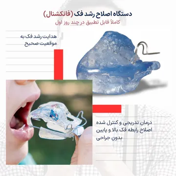 درد دستگاه فانکشنال ارتودنسی؛ آیا اصلاح رشد فک درد دارد؟ تصویر دستگاه فانکشنال ارتودنسی کودکان برای اصلاح رشد فک بالا و پایین که با اعمال نیروی تدریجی باعث بهبود رابطه فکی شده و معمولاً درد خفیف و موقتی ایجاد میکند.