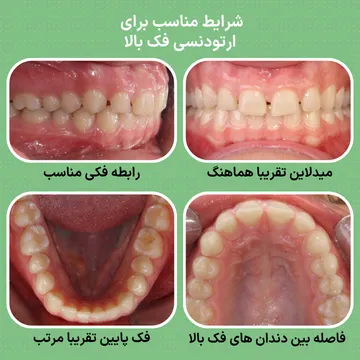 شرایط مناسب برای ارتودنسی فک بالا رابطه فکی مناسب، میدلاین هماهنگ و نامرتبی خفیف تا متوسط دندان های فک بالا در بیماری با فک پایین مرتب؛ نمونه ای از شرایط قابل درمان با ارتودنسی فک بالا