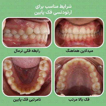 نمونه مناسب برای ارتودنسی فک پایین با بایت طبیعی بایت طبیعی و فک بالای مرتب در کنار نامرتبی دندان های فک پایین؛ نمونه ای از شرایط مناسب برای ارتودنسی فک پایین