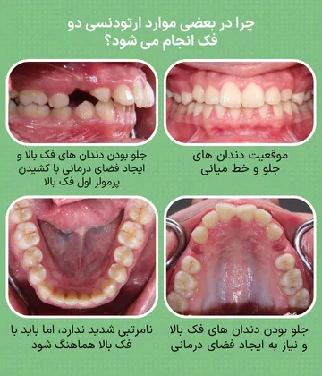 نمونه ای از نیاز به درمان دو فک با وجود مشکل اصلی در فک بالا بیمار با جلو بودن دندان های فک بالا و کشیدن پرمولرهای اول فک بالا برای ایجاد فضای درمانی؛ نمونه ای از شرایطی که ممکن است درمان هر دو فک توصیه شود