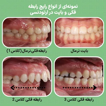 مقایسه بایت کلاس 1، کلاس 2 و کلاس 3 در ارتودنسی تصویر آموزشی انواع بایت در ارتودنسی شامل کلاس 1، کلاس 2 و کلاس 3 و تفاوت رابطه دندانهای فک بالا و پایین