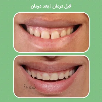 نتیجه ارتودنسی تک فک؛ مقایسه قبل و بعد درمان عکس قبل و بعد ارتودنسی فک بالا با بهبود نظم دندانها و زیبایی لبخند
